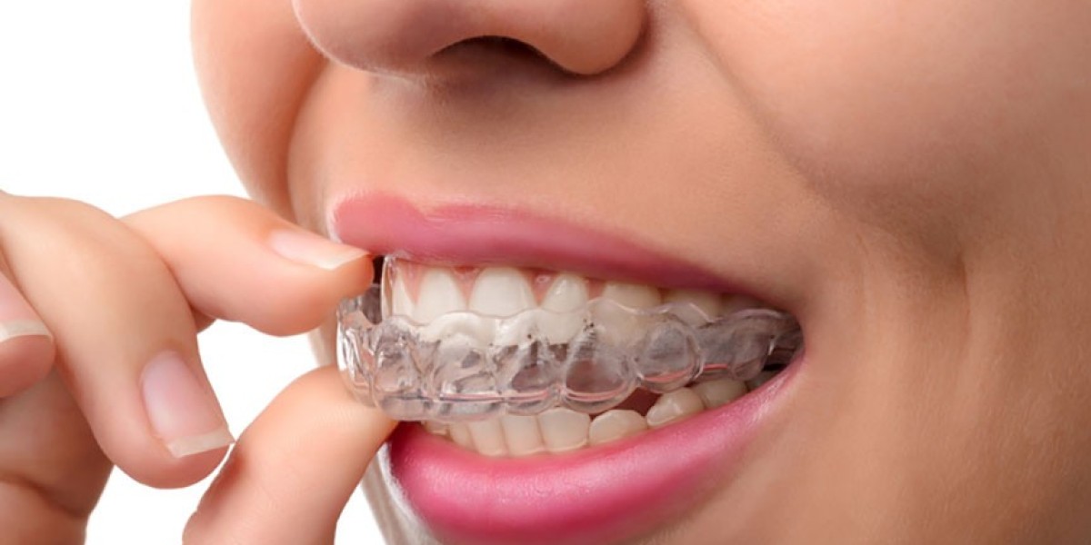 What Benefits Does Invisalign Offer?